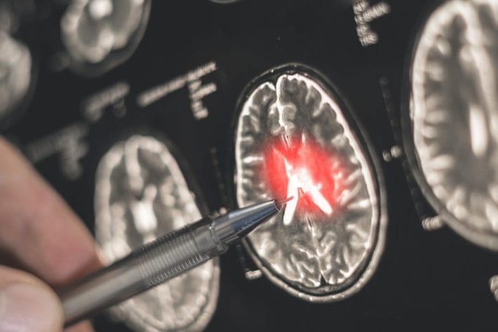dinner habit Alzheimer’s risk
